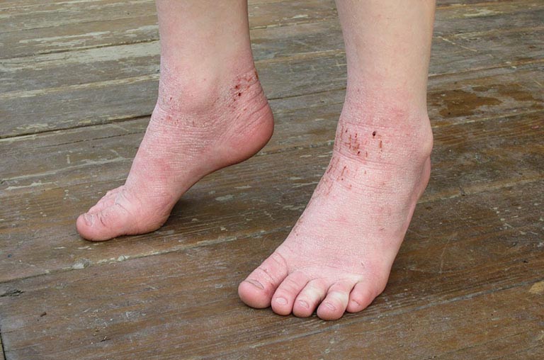 Viêm da cơ địa ở tay chân cần được phát hiện và điều trị đúng cách từ sớm
