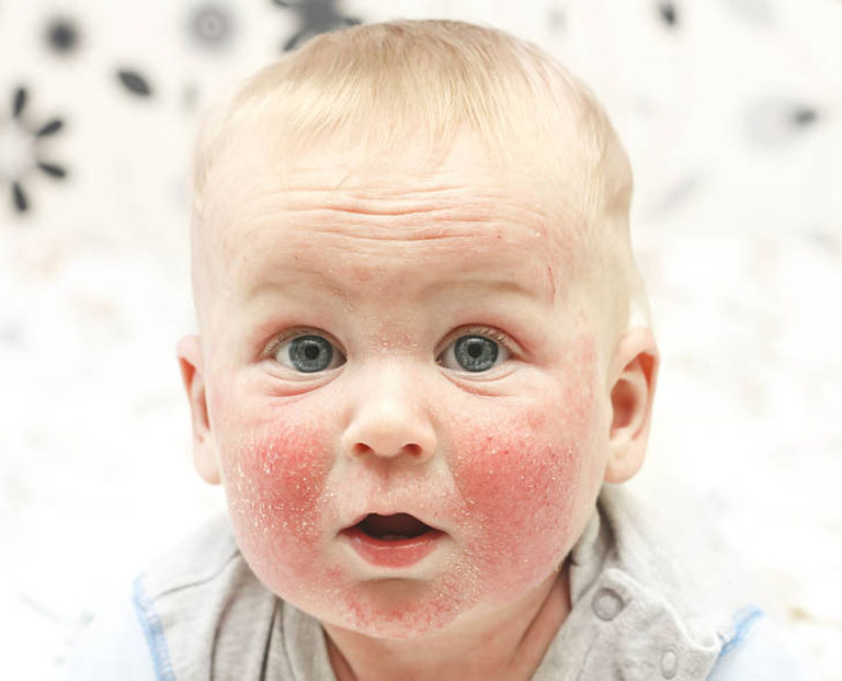 Bệnh viêm da cơ địa khởi phát ở vùng da mặt của trẻ sơ sinh