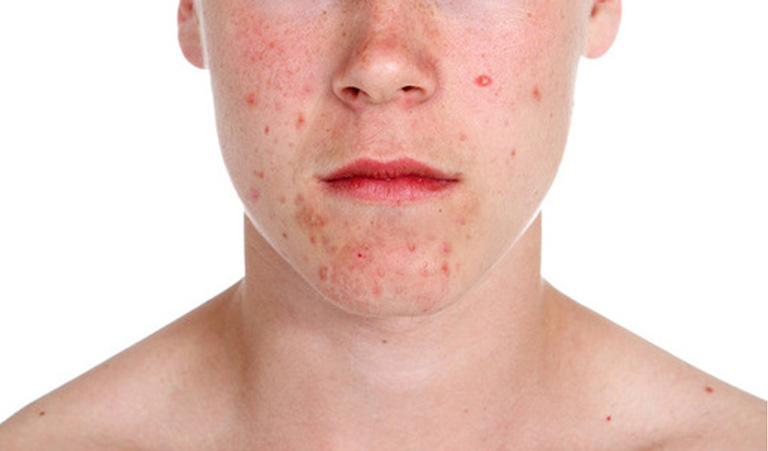 11 Cách chữa dị ứng da mặt tại nhà an toàn hiệu quả