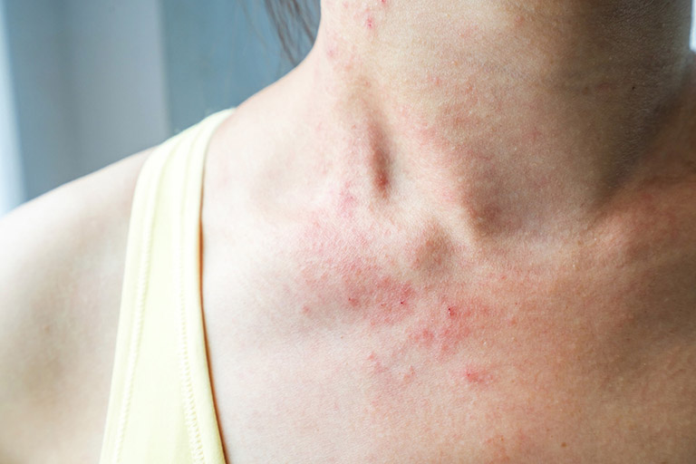Dị ứng hải sản thường gây ra tình trạng nổi mề đay, sẩn ngứa trên da