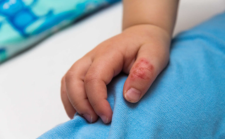 Bệnh tổ đỉa ở trẻ em: Nguyên nhân, dấu hiệu nhận biết và điều trị
