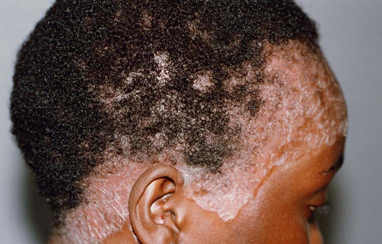 Bệnh vẩy nến da đầu: Nguyên nhân, Dấu hiệu và Điều trị