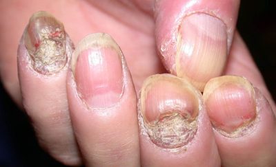 Bệnh vảy nến móng tay, chân: Nguyên nhân và cách điều trị