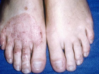 Ringworm fungal infection of the foot