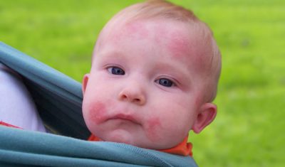 Bệnh hắc lào ở trẻ sơ sinh: Nguyên nhân và cách điều trị an toàn