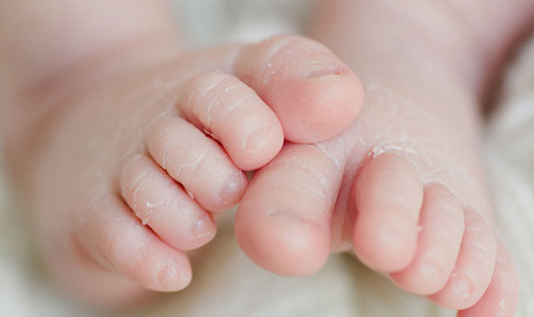 Các dạng vảy nến xuất hiện ở trẻ sơ sinh