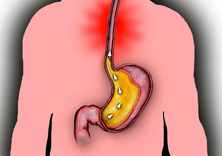 Chít hẹp thực quản là một trong những nguyên nhân gây ra tình trạng khó thở ở người bị trào ngược dạ dày
