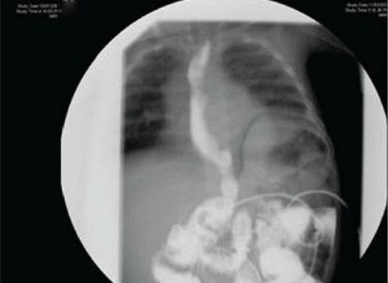 Hình ảnh chụp X-Quang đại tràng cản quang