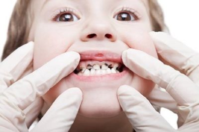 Bé 3 tuổi bị sâu răng thường cảm thấy khó chịu, đau nhúc