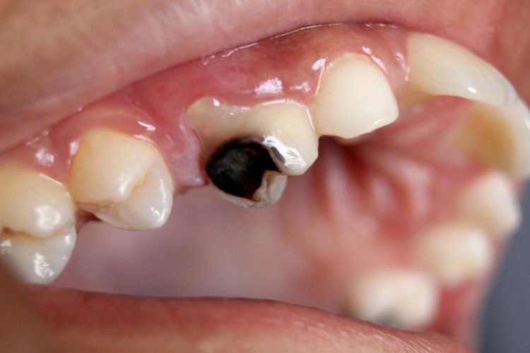 Bé 5 tuổi bị sâu răng có thể do ăn quá nhiều đồ ngọt