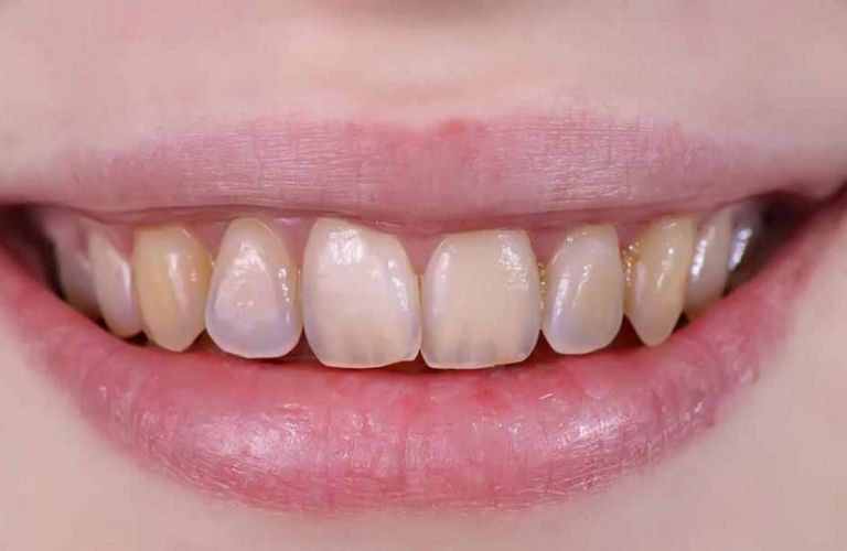 Mòn men răng: Nguyên nhân, dấu hiệu và cách điều trị hiệu quả