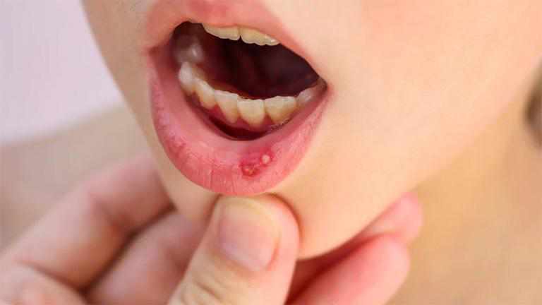 Khi bị nhiệt miệng, người bệnh sẽ thấy vết loét nhỏ màu trắng hoặc hồng hình ovan