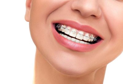 Niềng răng là gì? Lợi ích, Đối tượng và Phân loại niềng răng