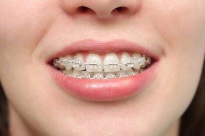 Niềng răng không nhổ răng áp dụng tùy trường hợp