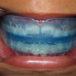 Niềng răng Trainer cho người lớn có hiệu quả hay không? Giải đáp chi tiết
