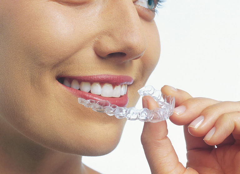 Niềng răng Clear Aligner đạt hiệu quả chỉnh nha tốt và an toàn cho người dùng