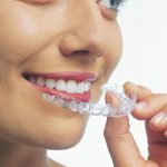 Niềng răng vô hình Clear Aligner là kỹ thuật gì? Quy trình và chi phí ra sao?