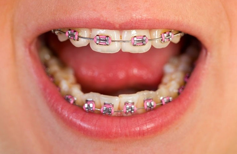 Niềng răng xong bị móm có thể là do lựa chọn phương pháp niềng không phù hợp