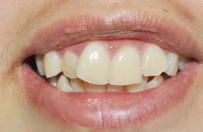 Răng lệch nhân trung là hiện tượng khá phổ biến