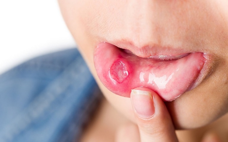 Nhiệt miệng là bệnh lý dễ gặp, gây đau đớn và khó chịu cho người bệnh