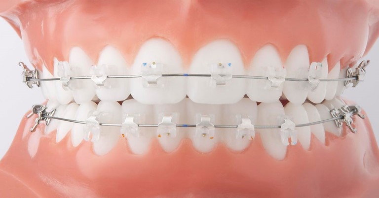 Chi phí niềng răng mắc cài pha lê thường cao hơn mắc cài kim loại
