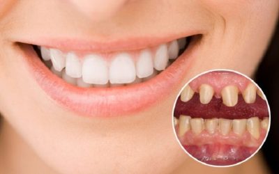 Bọc răng sứ giá rẻ TPHCM nên hay không? Ở đâu uy tín?