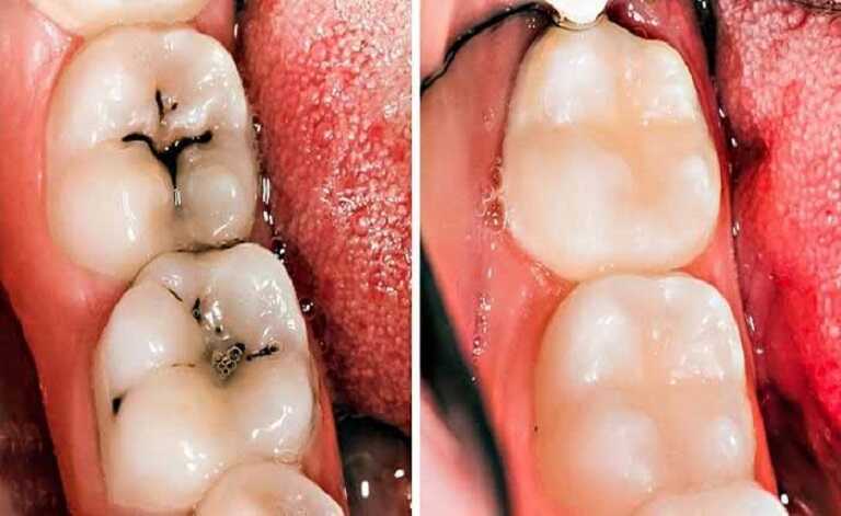 Hiệu quả của phương pháp bọc sứ cho răng sâu