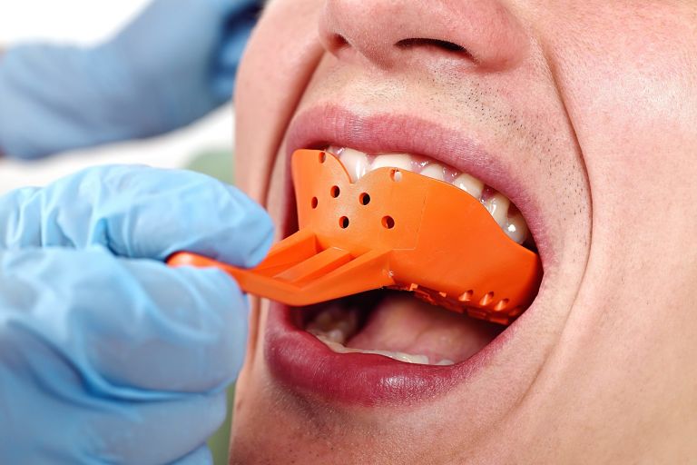 Lấy dấu hàm và thiết kế mắc cài là giai đoạn quan trọng khi niềng răng