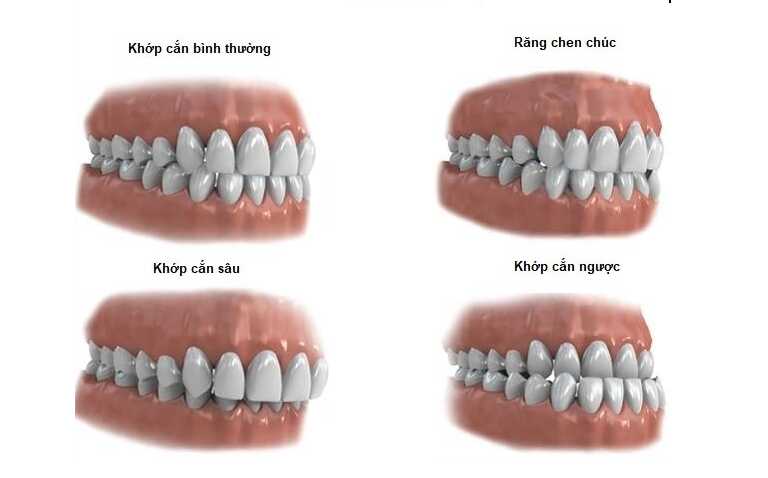 Chi phí niềng răng 1 hàm phục thuộc vào tình trạng và mức độ sai lệch của các răng