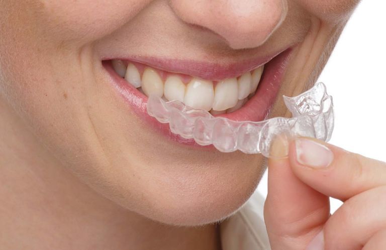 Niềng răng 3D Clear có ưu điểm là giá thành hợp lý, hiệu quả cao