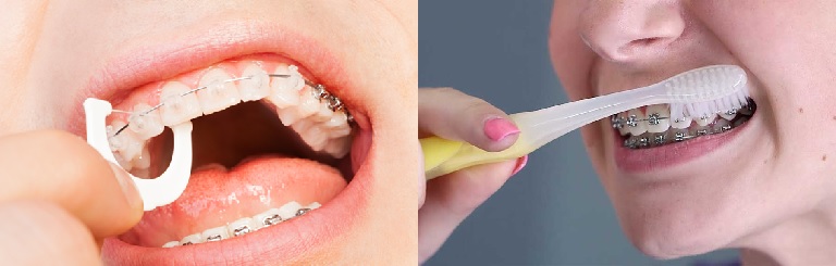 Chăm sóc răng miệng kỹ càng và đúng cách trong quá trình niềng để tránh thức ăn bám vào mắc cài