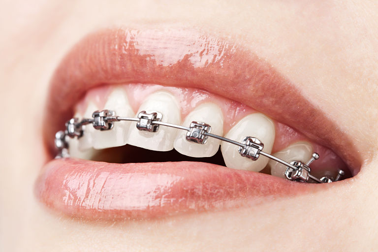 Niềng răng mắc cài kim loại là kỹ thuật chỉnh nha truyền thống