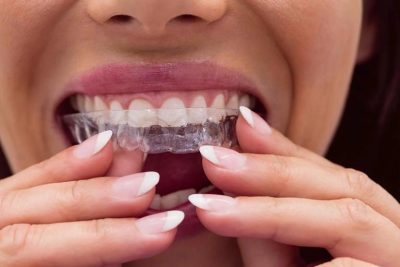 Thực hiện niềng răng tại nhà có hiệu quả không? Các cách niềng răng tại nhà phổ biến