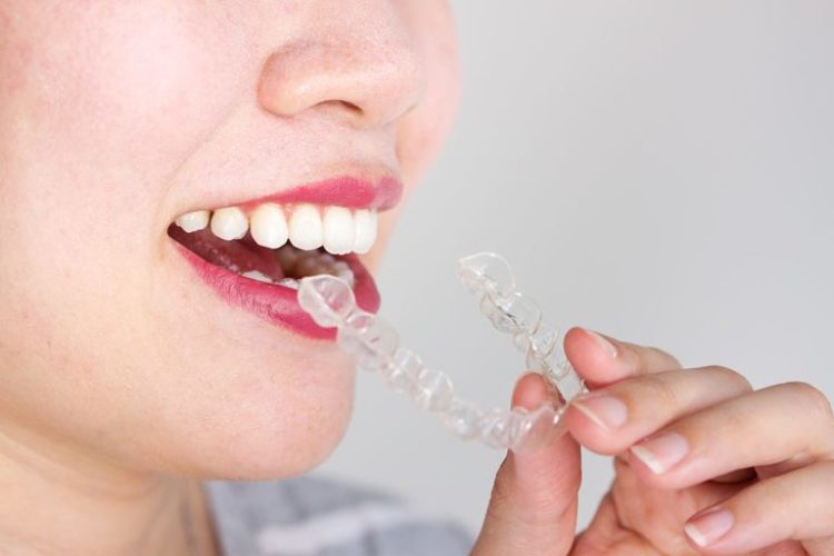 Niềng răng tháo lắp là gì? Phương pháp này chỉnh nha này có hiệu quả không?