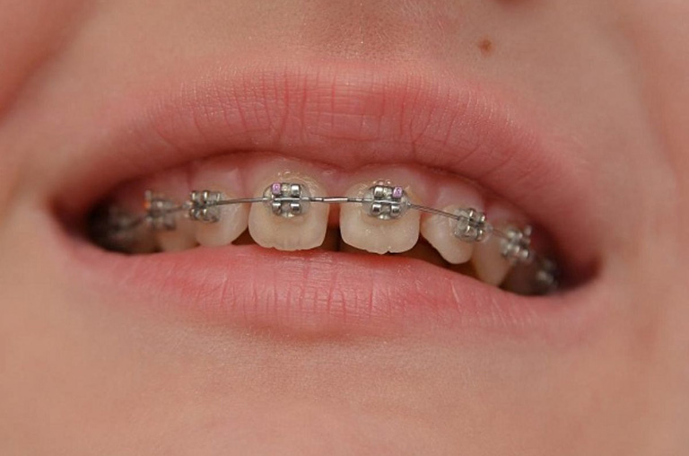 Phương pháp niềng răng mắc cài kim loại