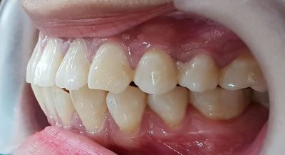 Răng hô nặng là gì? Các phương pháp khắc phục răng hô nặng