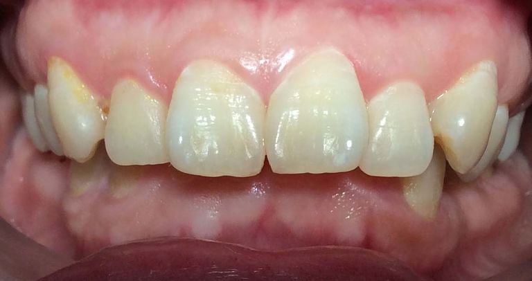 Răng hô nhẹ: Nguyên nhân và cách điều trị triệt để