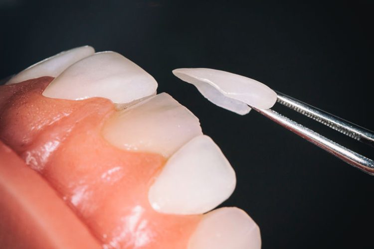 Răng sứ Veneer là gì? Kỹ thuật dán răng sứ Veneer có tốt không?
