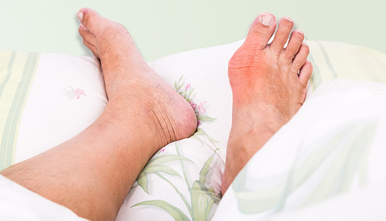 Bệnh gout thường đau ở đâu? Ngón chân cái là vị trí thường gặp nhất