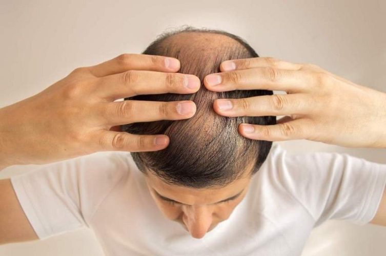 Nguyên nhân hóa trị rụng tóc và các biện pháp khắc phục