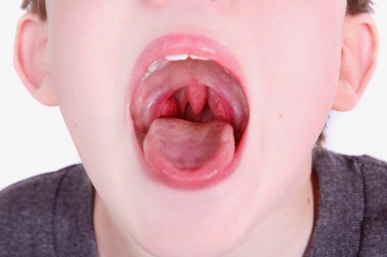 Tình trạng viêm họng, viêm amidan của trẻ hình thành do tác nhân có hại từ môi trường xâm nhập vào cơ thể qua đường hô hấp