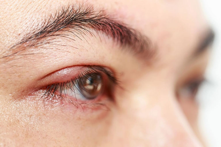 Lẹo mắt khá phổ biến và có nhiều cách chữa trị