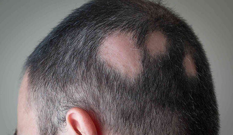Rụng tóc từng mảng mô tả căn bệnh dẫn đến các mảng hói trên da đầu