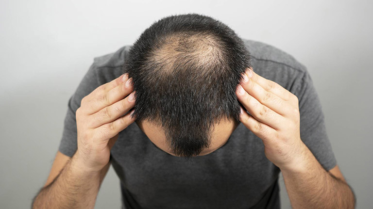 Nam giới là đối tượng thường gặp các triệu chứng rụng tóc