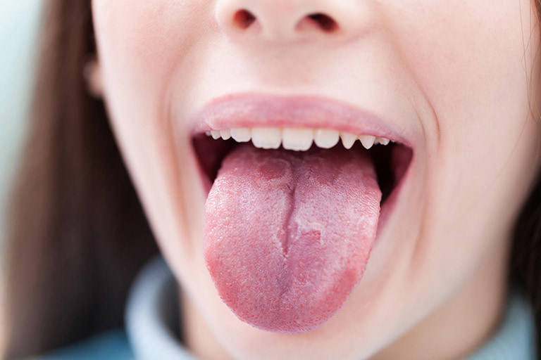 Rát lưỡi là một biểu hiện dễ gặp do nhiều nguyên nhân gây ra gây khó chịu cho người bệnh