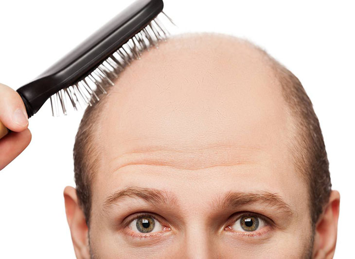 Cách trị hói đầu ở nam giới cực kỳ hiệu quả không phải ai cũng biết  Cấy  Tóc Quốc Tế