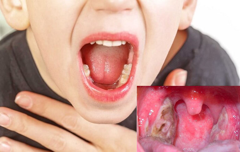 Viêm họng mủ trắng là bệnh lý đường hô hấp dễ gặp phải ở mọi lứa tuổi khác nhau