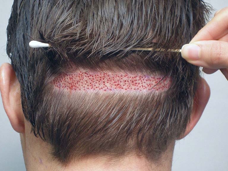 Đây là kỹ thuật cấy tóc đảm bảo tính thẩm mỹ cao