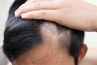 Dấu hiệu tóc yếu cảnh báo bệnh gì Cách chăm sóc và khắc phục