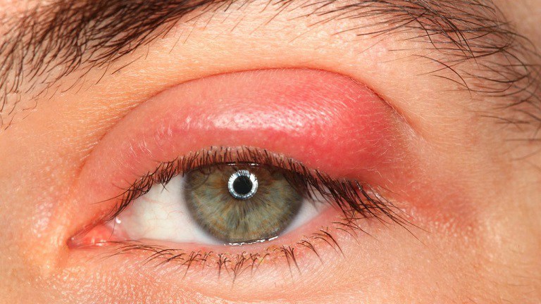 Mẹo mắt thường gây ra các hiện tượng như sưng mí, tấy đỏ, mưng mủ